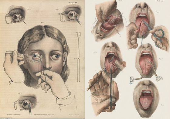 救溺水的人就是要從屁股吹氣？17世紀歐洲超驚悚的開刀術 開刀、急救、醫術、麻醉、醫療