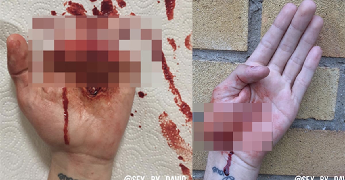 把自己手掌斬斷有快感嗎？英國男孩自學特殊血腥裝嚇壞眾人 斷掌、血腥、恐怖片、傷口、逼真
