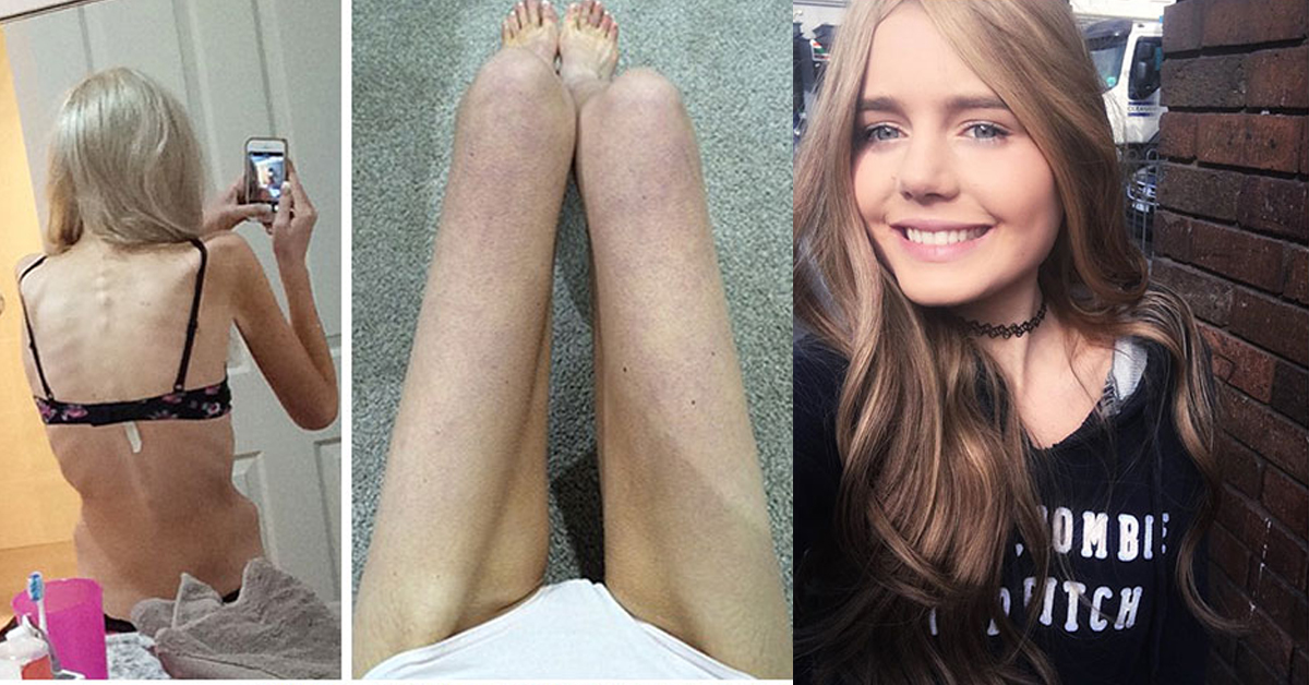 不吃真的沒有比較美！克服厭食症的前後對比照讓人很想立刻大吃一頓 厭食症、美、審美觀、價值、瘦、過瘦、生病、精神疾病