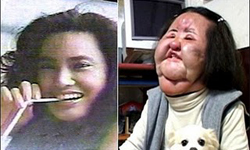難以直視的DIY手術結果！將臉部注射食用油的韓國前女模 恐怖、詭異、噁心、噩夢、惡夢、整形、手術、食用油、油、韓國、上癮、病態、Hang Mioku