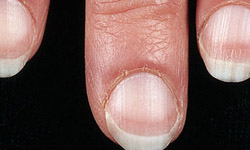 把手伸出來！從指甲抽查你的健康狀況 指甲、健康、甲面、蒼白、剝落