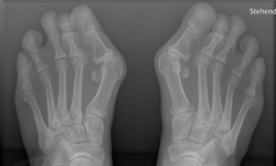 拇指外翻是會呼吸的痛！各式各樣的拇指外翻 拇指外翻、恐怖