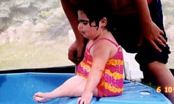 魚尾巴女孩 小美人魚綜合症 人魚綜合症、人魚、尾巴、魚尾、案例