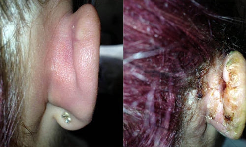 穿完耳洞細菌蝕骨　女大生半耳潰爛切除 女大生、新生入學、漂亮、穿耳洞、不幸