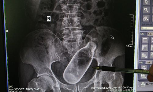 男肛門內卡大瓶　辯稱「我在通便秘」醫生傻眼 肛門、直腸、腸道、急救、痛