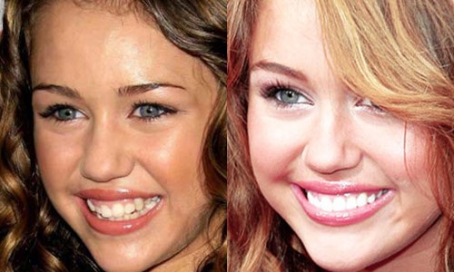 戴牙套的牙齒就是這樣移動的！縮時影片讓你看見奇蹟 牙套、牙齒、移動