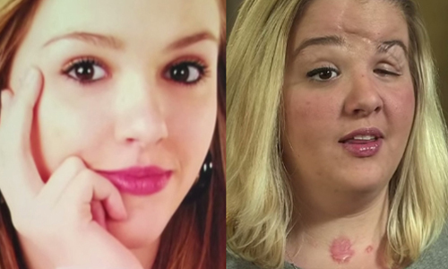 給低頭族的警告！一封簡訊讓20歲正妹毀容、失明 低頭族、車禍、毀容、失明、教訓、警告