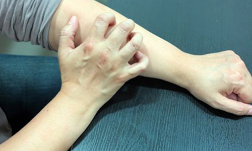 洗澡勿過度清潔！冬日對抗乾燥肌守則 健康醫療網、皮膚、乾燥、搔癢、脫屑、冬季癢、缺脂性皮膚炎、乾燥性溼疹