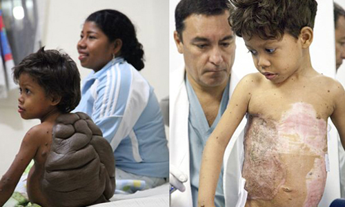 背上黑痣碩大如龜殼！「烏龜男孩」術後脫殼重生 哥倫比亞、龜殼、背、腫瘤、歧視