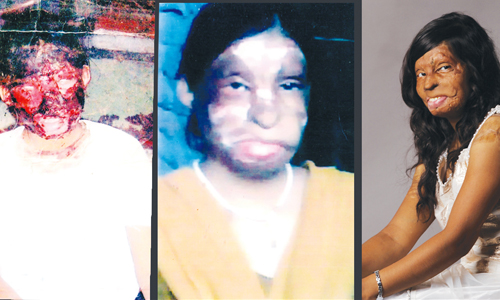 恨你就潑你硫酸！印度毀容女從無法見人到走出陰霾... Rahul Saharan、Shoot for Beauty、硫酸、毀容、印度