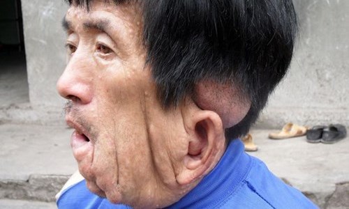 融化的五官讓他看不到是誰在霸凌他！更多顏面畸形者的心酸故事 神經纖維瘤、殘缺、心酸、醫療、窮困