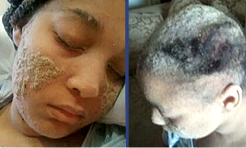 體毛變體甲！女罹怪病、全身毛囊長滿指甲 美國、女子、神秘、怪病、皮膚