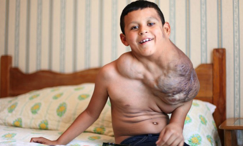 頸部怪瘤即將吞噬男童  國安局總動員助重生 墨西哥、男孩、腫瘤、靜脈型淋巴瘤、危險