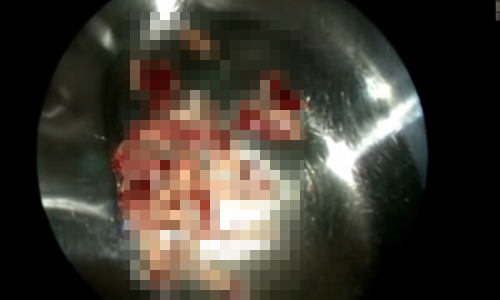 噁心程度爆表！印度男鼻腔藏50隻大肥蛆 活蛆、蠕動、鼻腔、活力滿滿、跳舞