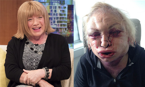 整容手術讓他變鬼娃恰吉！前拳擊教練術後內出血、頭腫如球 拳擊教練、變女人、女性向、整形、手術