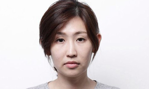皮鬆鬆讓你有「哀傷臉」？超音波電波拉皮能改善 健康醫療網、水滴魚症、憂傷魚、皮膚、鬆弛、光療、雷射、肌膚、老化