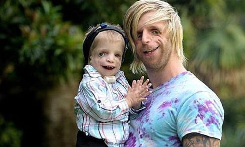 正妹女友讓他重拾自信！畸臉男橫跨地球散播勇氣 男童、先天基因異常、疾病、顴骨、視力、受影響、自卑、鼓勵、偶像、澳洲、男子、恢復、自信、勇氣、下頷骨顏面發育不全、Jono Lancaster、Zackary Walton、Treacher Collins Syndrome、崔契爾柯林斯症候群