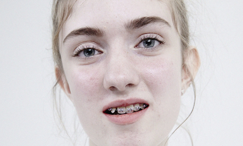 難道你沒看到自己的美麗嗎？7位牙套青少年對美的定義 Stef Mitchell、Hannah Cooper、審美觀、牙套、美