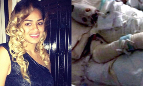 全身70%嫩肉皆灼傷！加州少女重度燒傷的原因竟是… 加州、少女、自燃、灼傷、危險