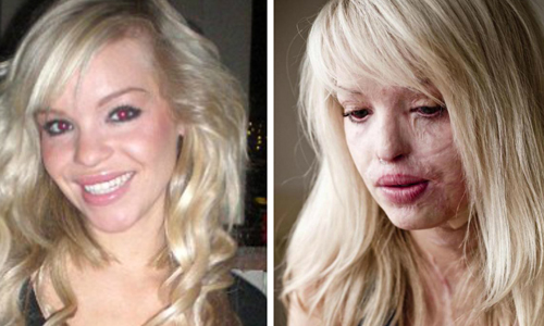 遭恐怖情人潑酸毀容　女模走出陰霾平安生女 恐怖情人、潑酸、硫酸、毀容、模特兒