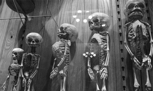 巨瘤、畸形胎通通在館內等你…馬特醫學標本博物館 費城、美國、馬特博物館、陰森、器官、人體、骨骸、腫瘤、屍體、感染、詭異、背脊發涼、恐怖、獵奇、嚇人、特別