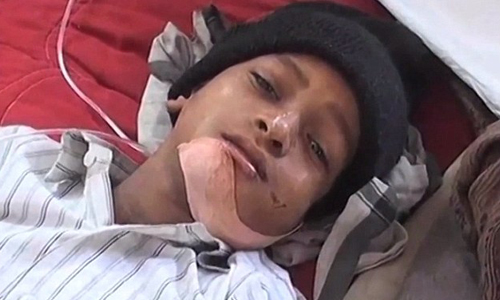 上顎塞滿80顆牙！7歲男童罹齒瘤、口內亂牙增生 印度、齒瘤、男童、腫瘤、良性腫瘤