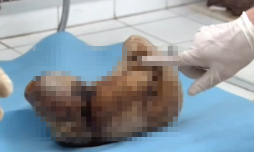 腹中胎兒已經46歲大！老婦剖腹產下神秘「石胎」 越南、石胎、摩洛哥、婦女、懷孕、難產、子宮、外孕、剖腹、陣痛、難受、麻痺、無感、石化、木乃伊