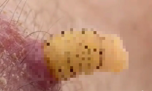 雞皮疙瘩狂起！男體內養蛆2個月、破肉鑽出全都錄 寄生、寄生蟲、蛆、蛆蟲、馬蠅