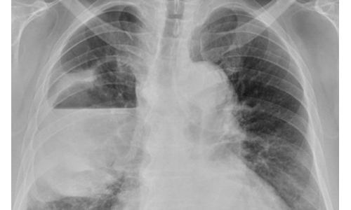 男子輕忽小感冒　竟演變為嚴重肺膿瘍 健康醫療網、肺膿瘍、細菌、感染、