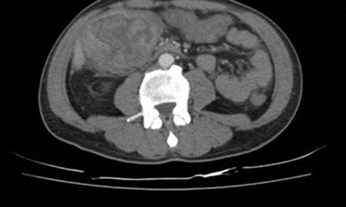 貧血、爬樓梯喘吁吁？小心大腸癌找上門！ 健康醫療網、缺鐵性貧血、大腸癌、爬樓梯