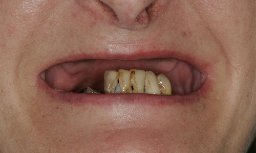 看完牙醫嘴巴空蕩蕩…麻醉醒驚覺上排牙不見 驚悚、恐怖、誇張、鎮定、藥物