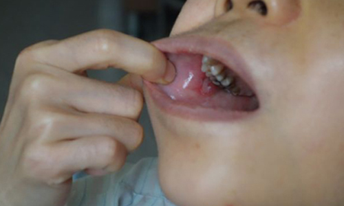 口腔反覆潰瘍多年　42歲女竟得貝歇氏症 健康醫療網、口腔潰瘍症、貝歇氏症、腸胃、潰瘍、虹彩炎