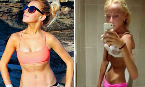 厭食症差點殺了她！少女不計代價追求超模身材險喪命 減肥、厭食症、厭食、少女、澳洲