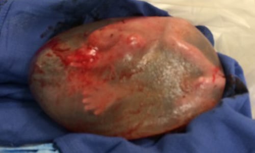 真正的「肉胎」長這樣！肉膜包嬰兒整球生出來 醫學、醫療、胎兒、嬰兒、嬰孩