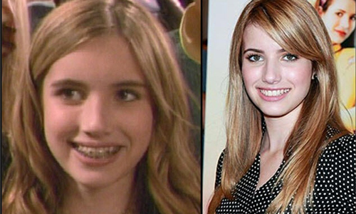 有戴沒戴差真多　盤點6位曾是牙套妹的女星 Emma Roberts、Emma Sotone、Blake Lively、Megan Fox、 gwen stefani