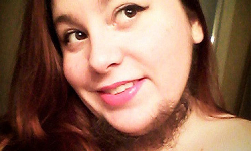 荷爾蒙失調導致滿臉鬍子  女子不放棄人生尋求真愛 荷爾蒙、女子、鬍子、結婚、婚姻