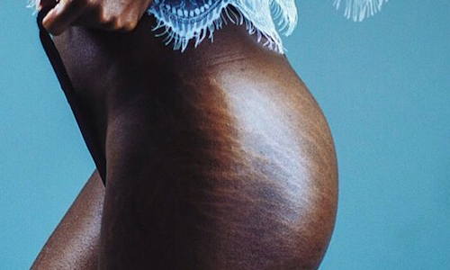 不是瑕疵，而是親密的夥伴！世界各地掀起女孩秀「紋」風潮 stretchies、Chrissy Teigen、Instagram、#loveyourlines、生長紋、妊娠紋、女孩、愛自己