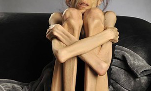 瘦到18公斤只剩一家醫院願意救！加州厭食症女子上傳影片請求網友金援 美國、女生、減肥、厭食症、疾病、治療、捐款、加州、爆瘦、體重、歪風