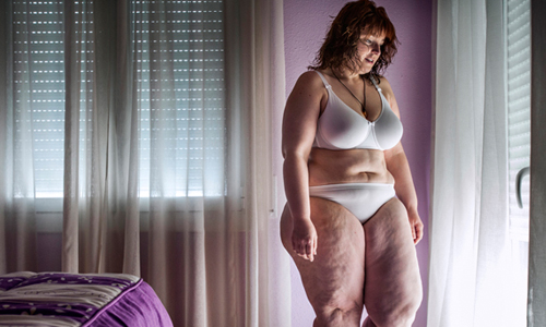 不想當一輩子的120公斤胖妹！胃繞道手術治療紀實攝影 Sandra、Alessandro Vincenzi、Metamorphosis、減肥、西班牙