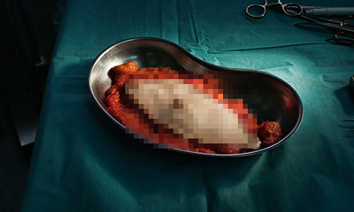 連截肢、腦瘤都拍到了！開刀手術的切除物攝影集 Maija Tammi、手術、切除、外科、腫瘤、截肢、攝影、大腸癌、乳癌、開刀、醫護人員、病人、結石、醫療、藝術