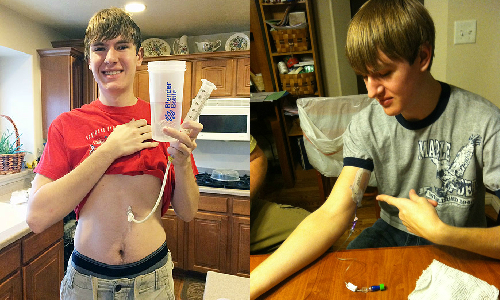 你能想像一輩子不能吃美食的人生嗎？少年罹罕病竟對所有食物過敏 過敏、食物、Alex Viskerx、食物過敏、疾病、罕見、詭異、獵奇