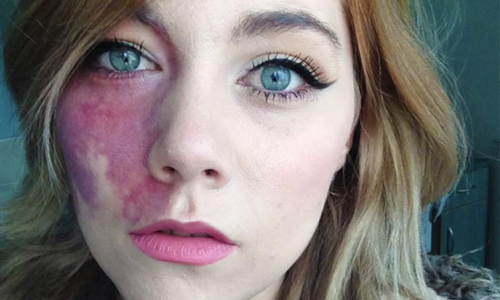 英國半邊臉胎記少女  勇敢卸妝素顏重獲新生 Lexxie Harford、胎記、英國、英國少女、鍾無艷