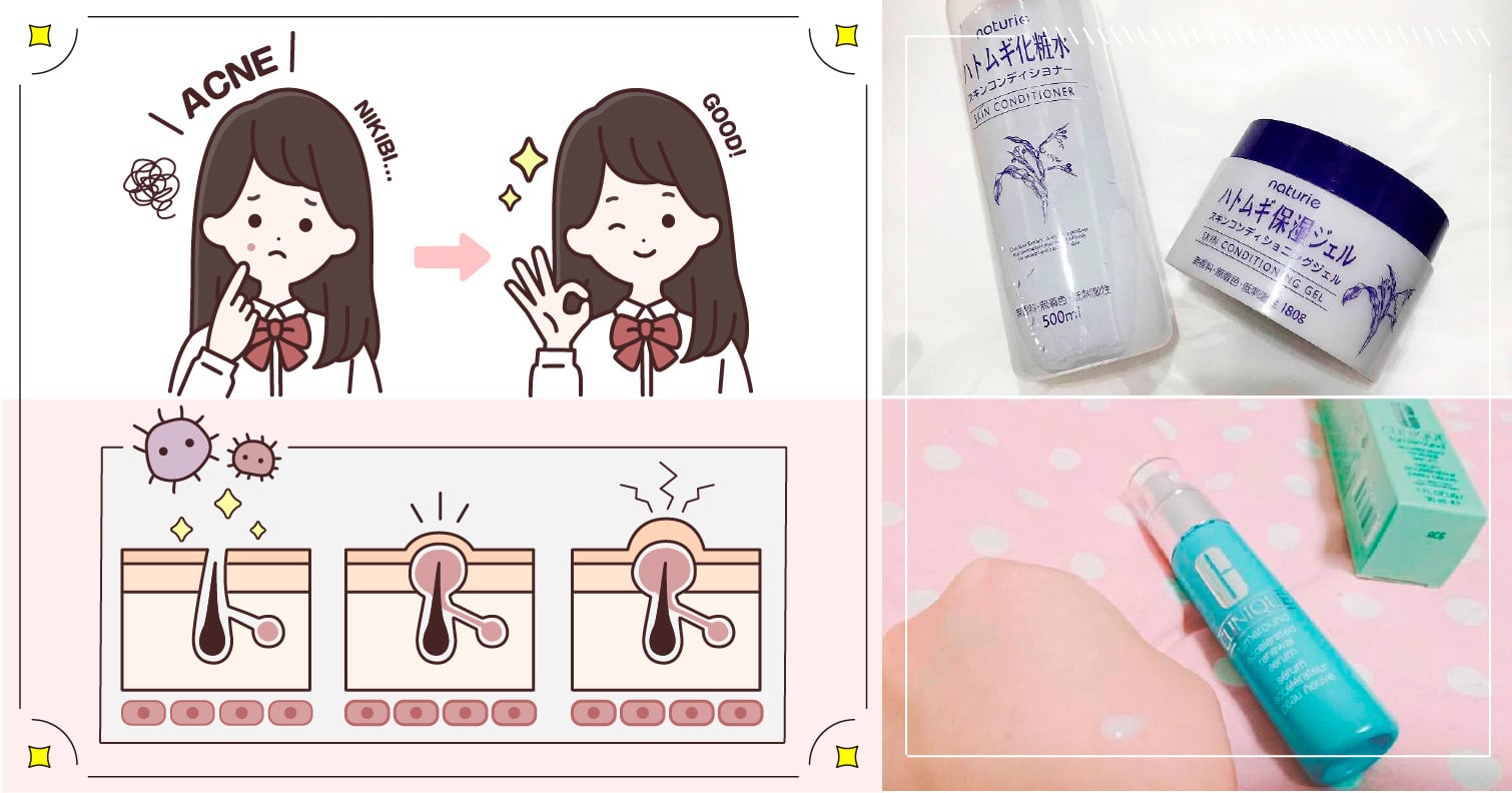 就算長痘痘，保濕也不能鬆懈！冒痘時可以使用的保濕產品大公開 抗痘、乳液、美容液、保濕液、護膚