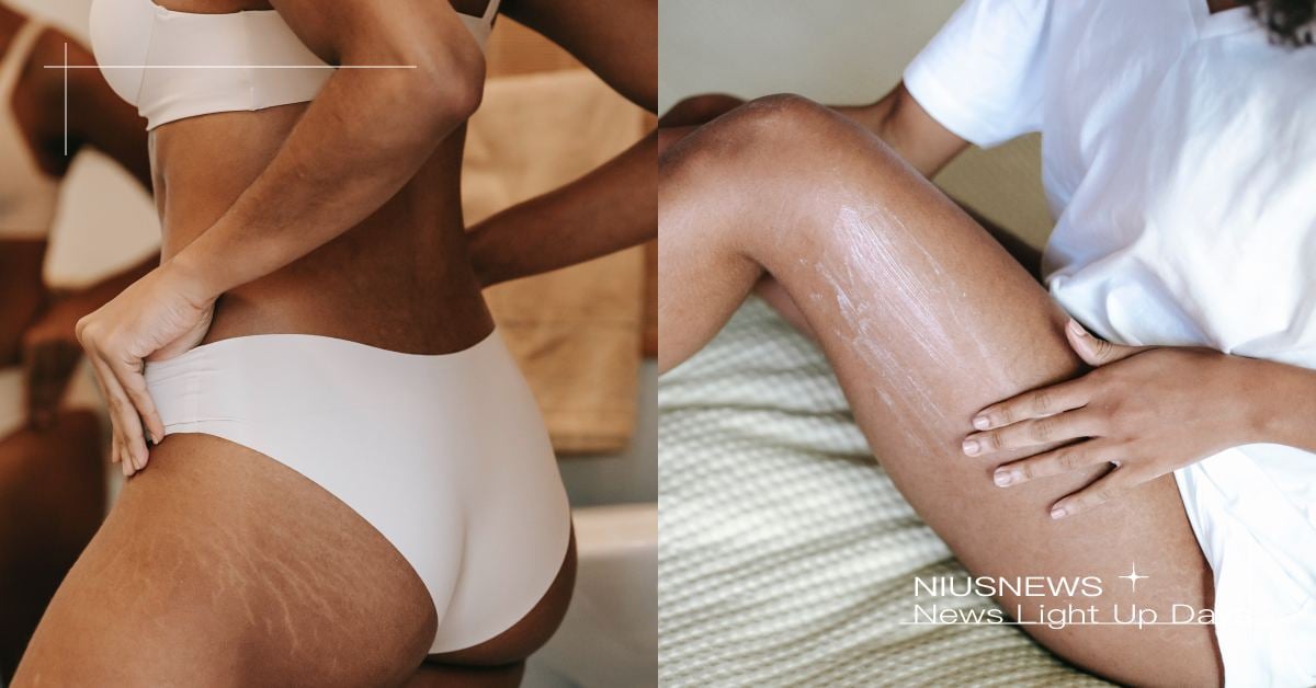 網友實測4招有效消除肥胖紋！為什麼會有肥胖紋？7大部位最容易形成 妊娠紋、肥胖紋、疤痕淡化、肥胖紋消除、肥胖紋成因