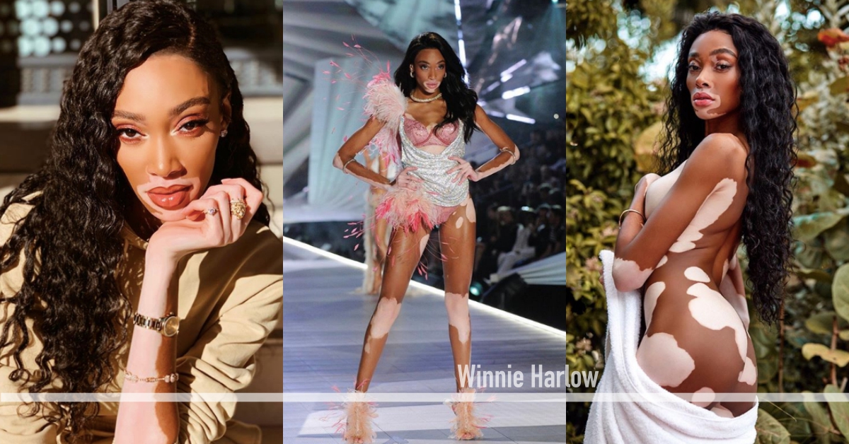 美麗不該只有一種樣態！揹上「維密翅膀」的白斑症超模Winnie Harlow 白斑症、模特兒、加拿大、超模、維多莉亞的秘密、內衣秀、WinnieHarlow、ChantelleBrownYoung、美國超級名模生死鬥