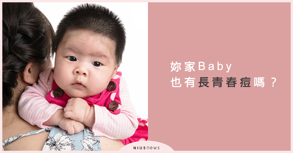 原來是「新生兒痤瘡」 家中Baby也長青春痘嗎？ 青春痘、清潔、治療、皮膚、嬰兒、新生兒痤瘡
